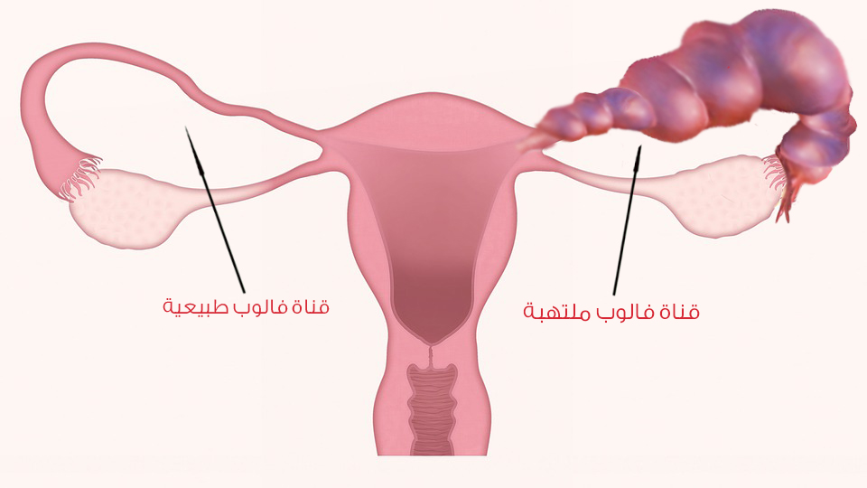 مضاعفات التهاب قنوات فالوب و اسبابها